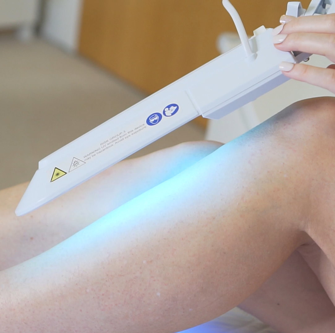 Narrowband uvb lamp for psoriasis 311nm